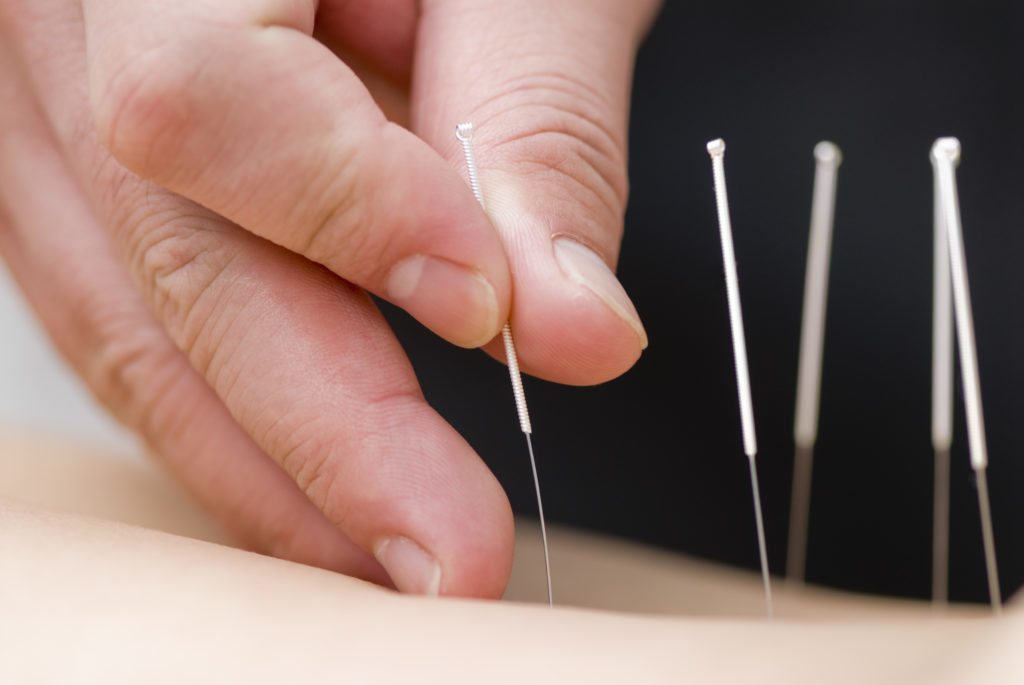 Acupuncture for fertility Frisco