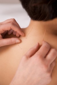 Acupuncture Frisco TX