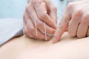 Acupuncture and weight loss