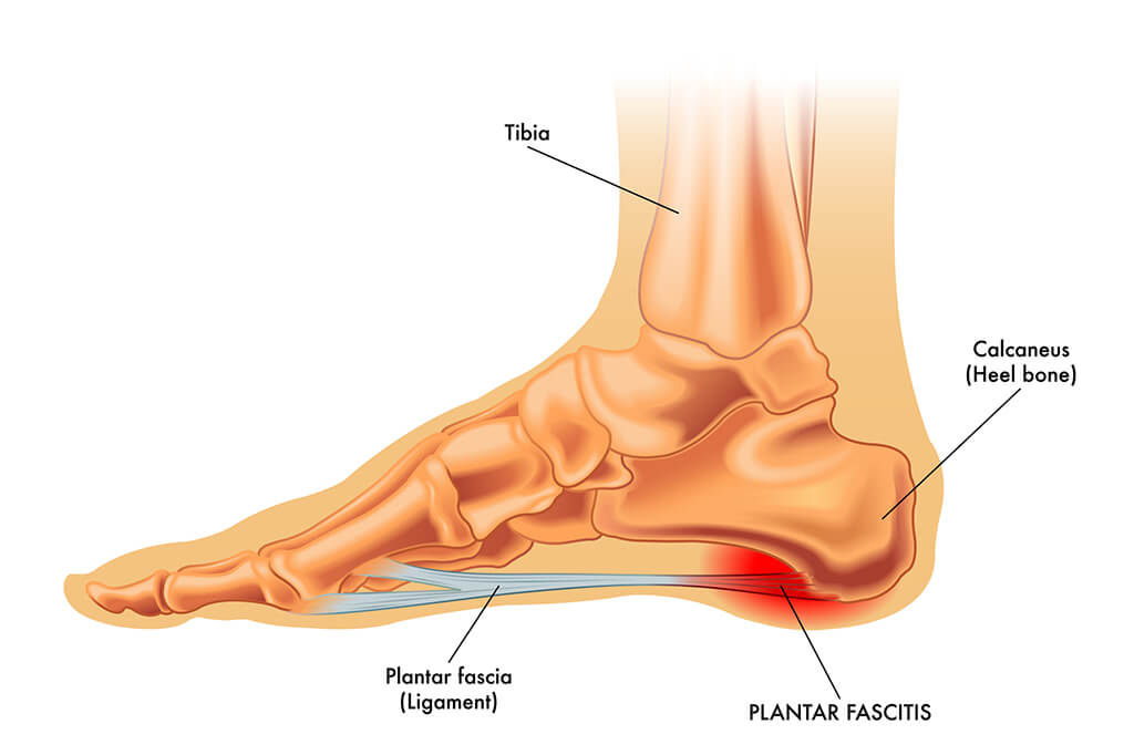 Foot Massage and Other Treatments for Plantar Fasciitis in Frisco