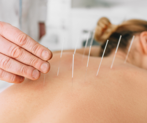 A woman with acupuncture needles in her back