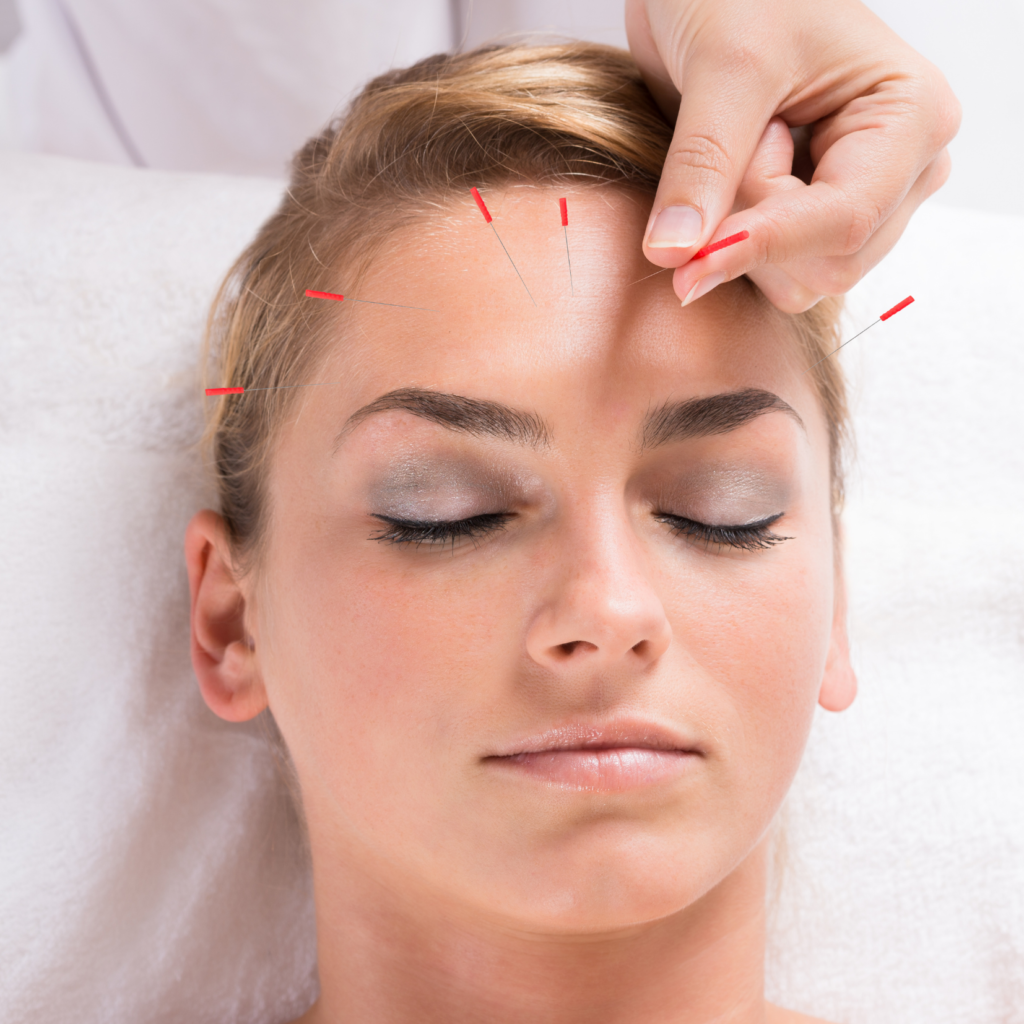 acupuncture and migraines